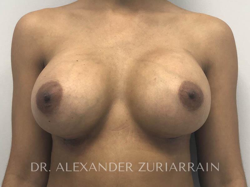 Breast augmentation before & after photo