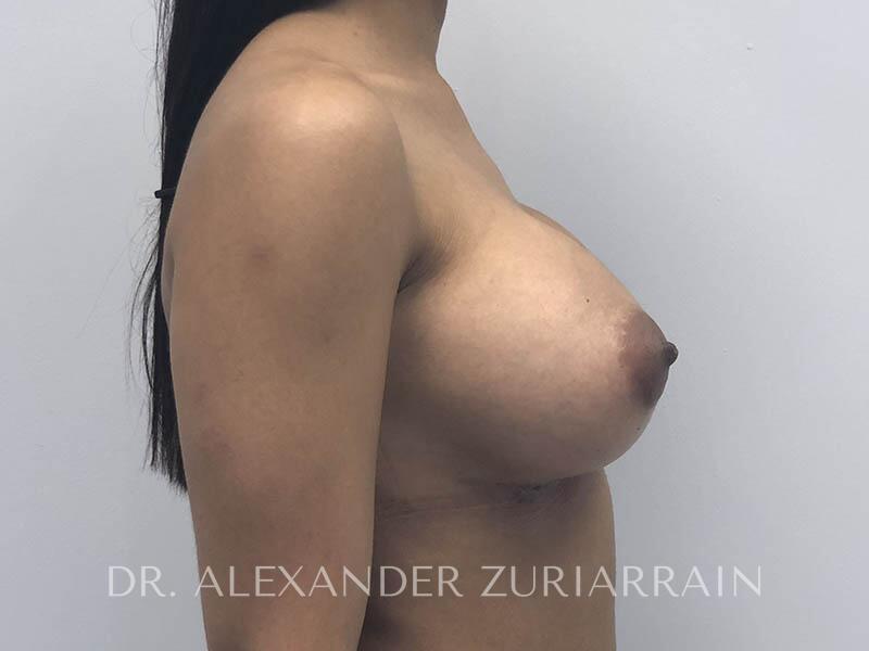 Breast augmentation before & after photo