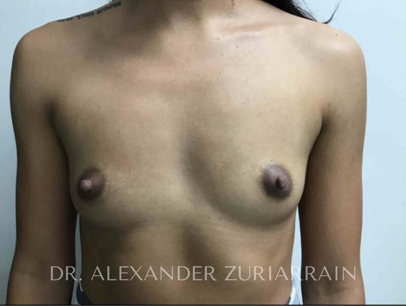 Breast augmentation before & after photo