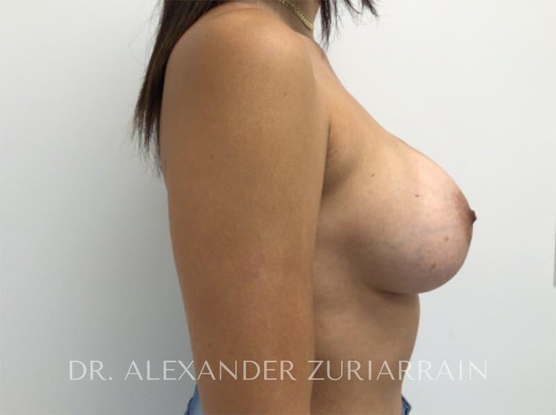 Breast augmentation before & after photo