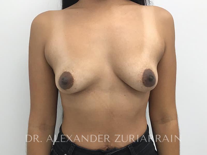 Breast augmentation before & after photo