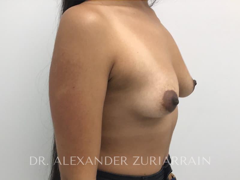 Breast augmentation before & after photo