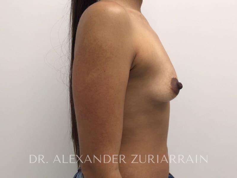 Breast augmentation before & after photo