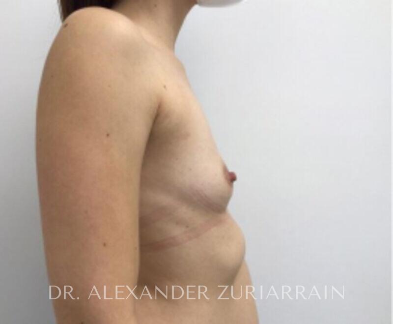 Breast augmentation before & after photo