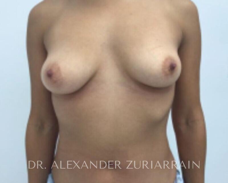 Breast augmentation before & after photo