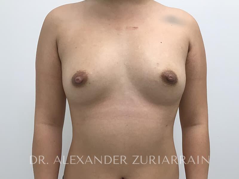 Breast augmentation before & after photo