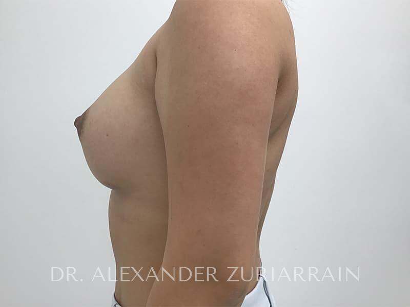 Breast augmentation before & after photo