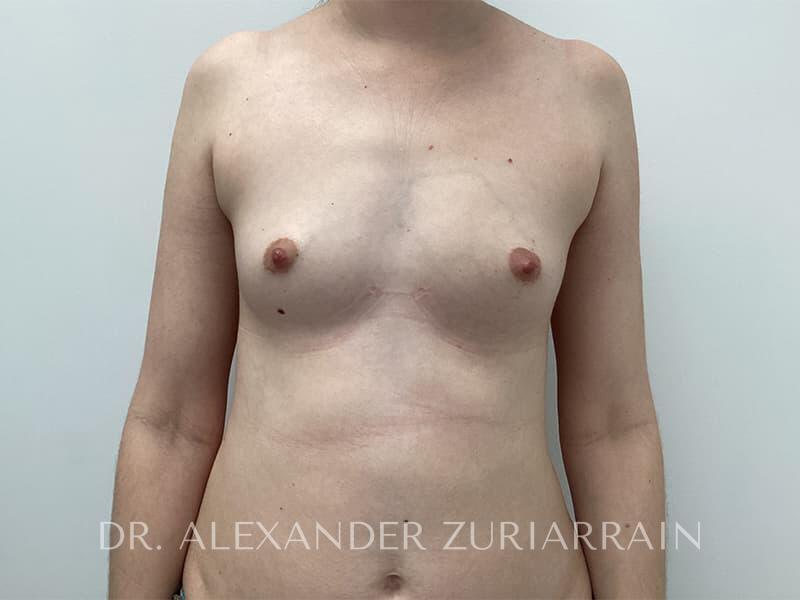 Breast augmentation before & after photo