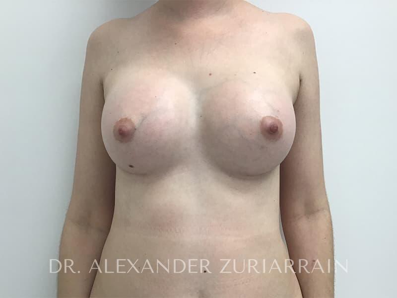 Breast augmentation before & after photo