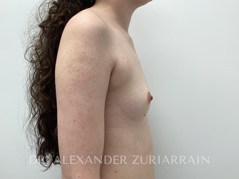 Breast augmentation before & after photo