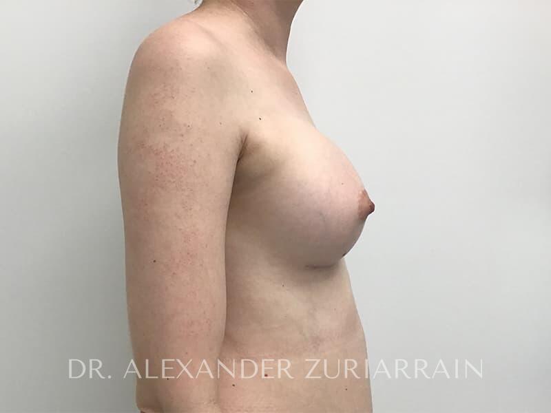 Breast augmentation before & after photo