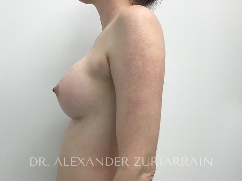 Breast augmentation before & after photo