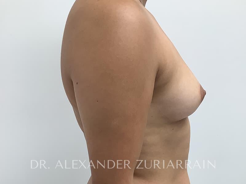 Breast augmentation before & after photo