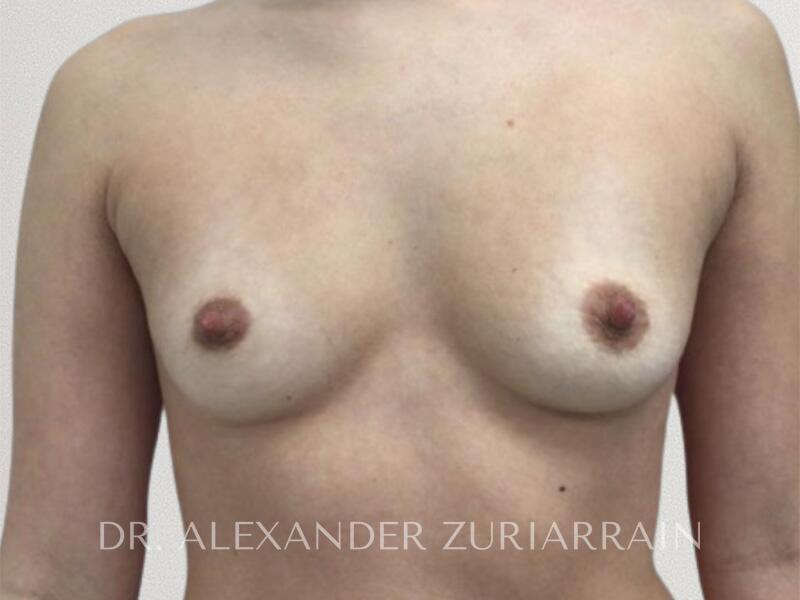 Breast augmentation before & after photo