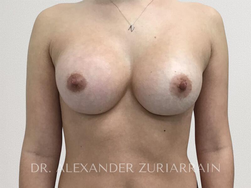 Breast augmentation before & after photo