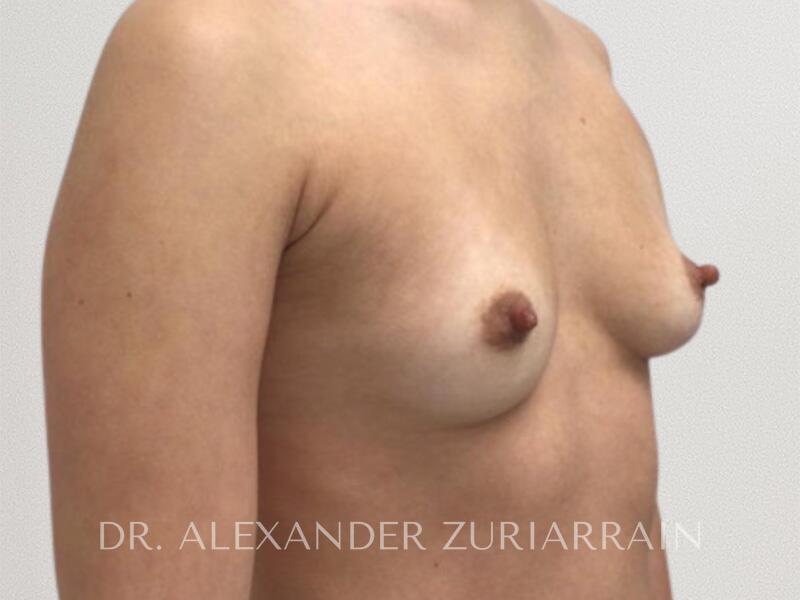 Breast augmentation before & after photo