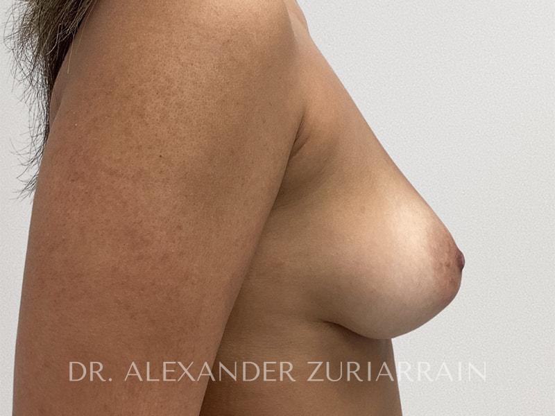 Breast augmentation before & after photo