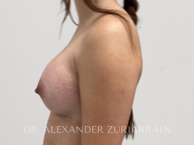Breast augmentation before & after photo