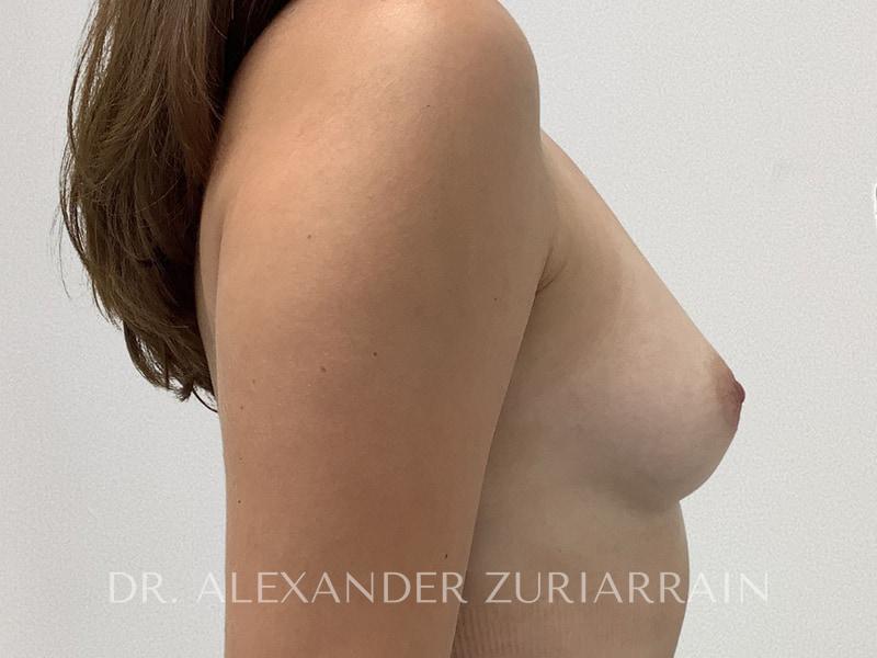 Breast augmentation before & after photo
