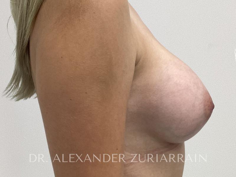 Breast augmentation before & after photo