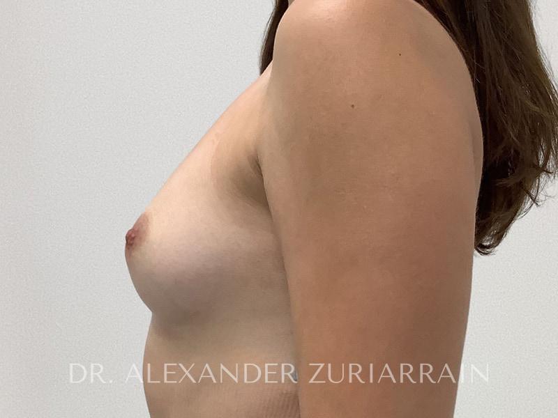 Breast augmentation before & after photo
