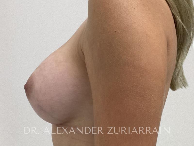 Breast augmentation before & after photo