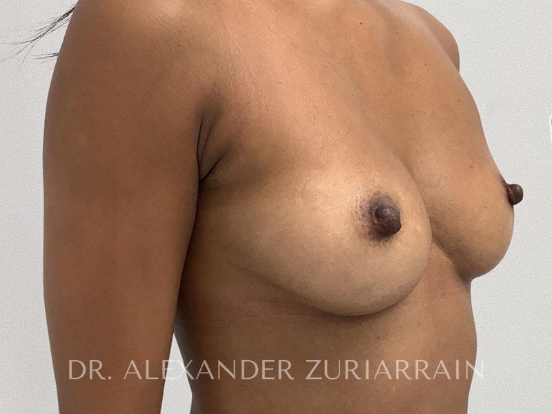 Breast augmentation before & after photo