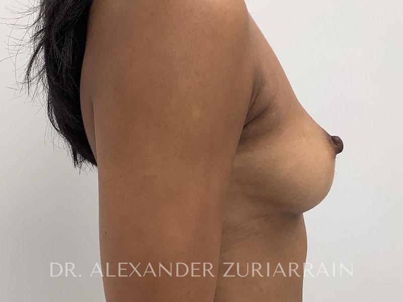 Breast augmentation before & after photo