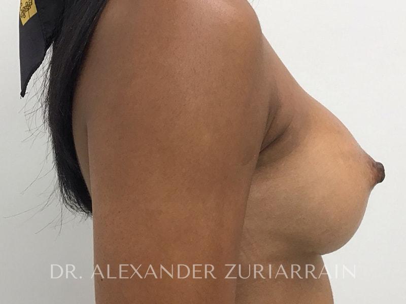 Breast augmentation before & after photo