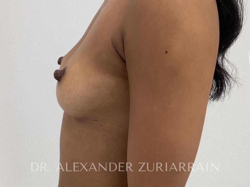Breast augmentation before & after photo
