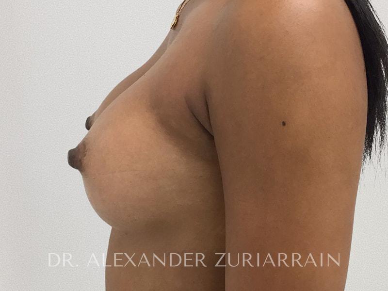 Breast augmentation before & after photo