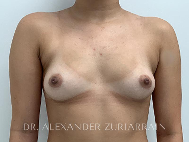 Breast augmentation before & after photo