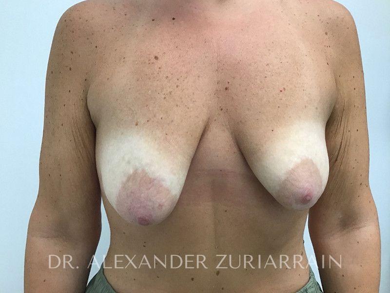 Breast augmentation before & after photo