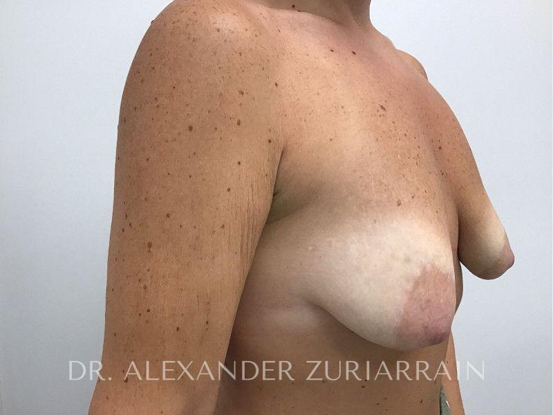 Breast augmentation before & after photo