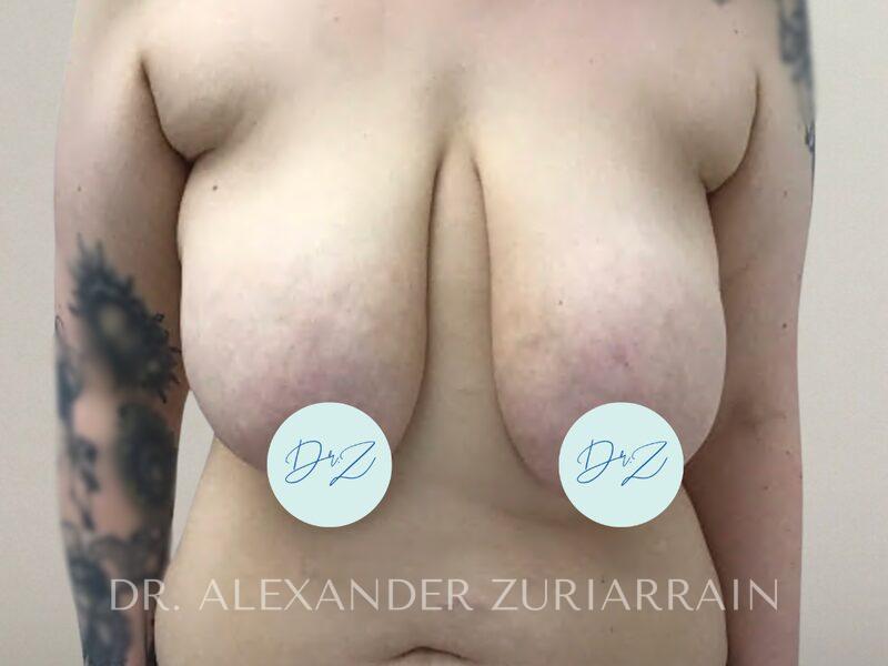 Breast augmentation before & after photo