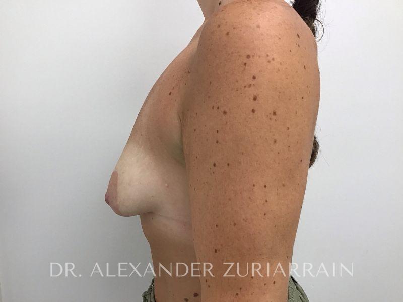 Breast augmentation with lift before & after photo