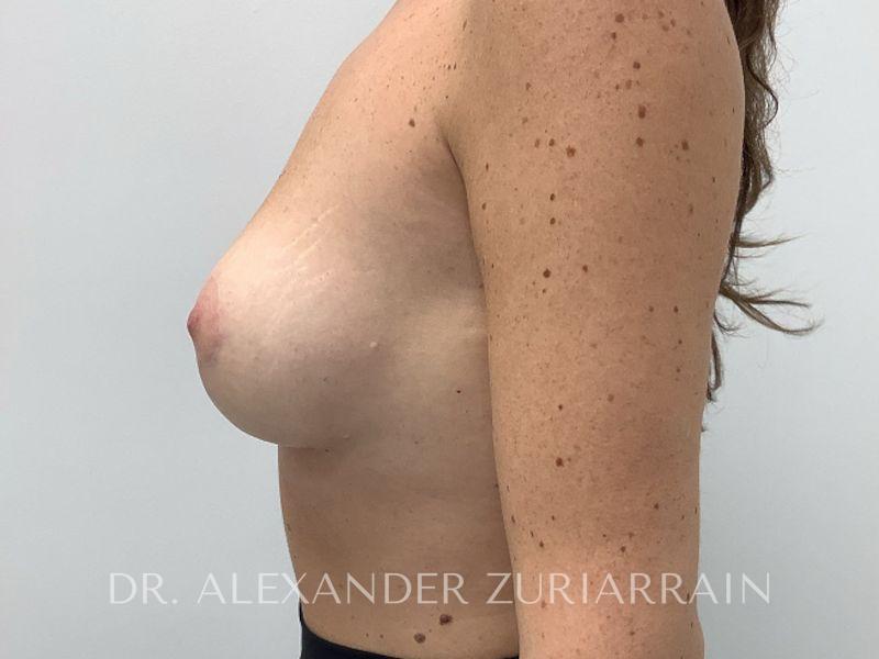 Breast augmentation with lift before & after photo