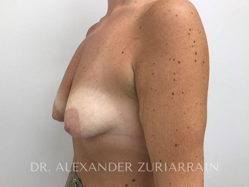 Breast augmentation with lift before & after photo