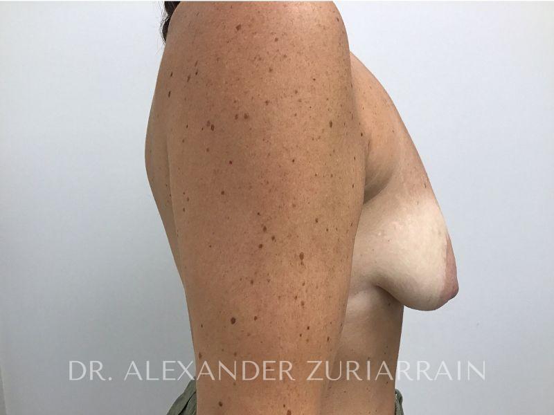 Breast augmentation with lift before & after photo