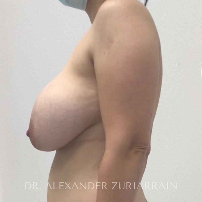 Breast implant removal with lift before & after photo
