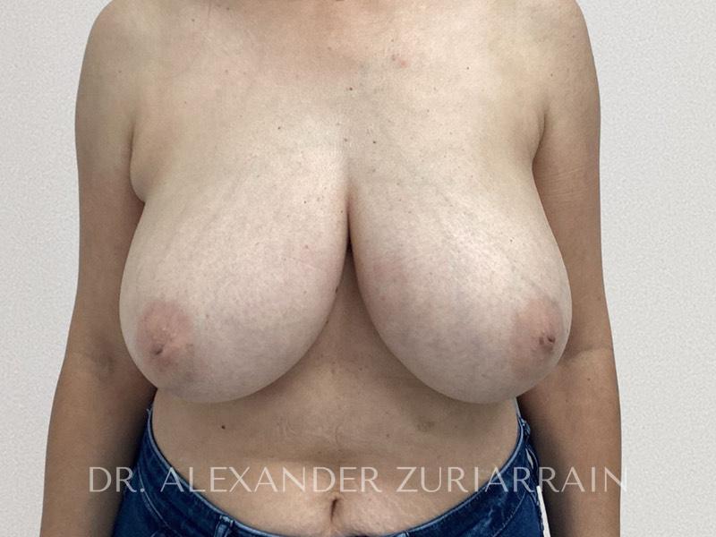 Breast reduction before & after photo