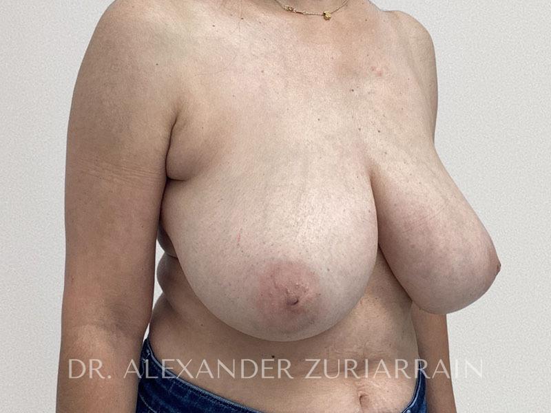 Breast reduction before & after photo