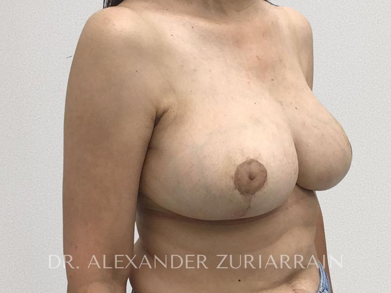 Breast reduction before & after photo