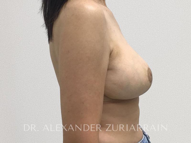 Breast reduction before & after photo