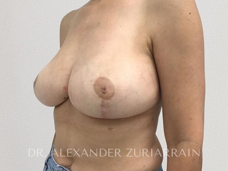 Breast reduction before & after photo