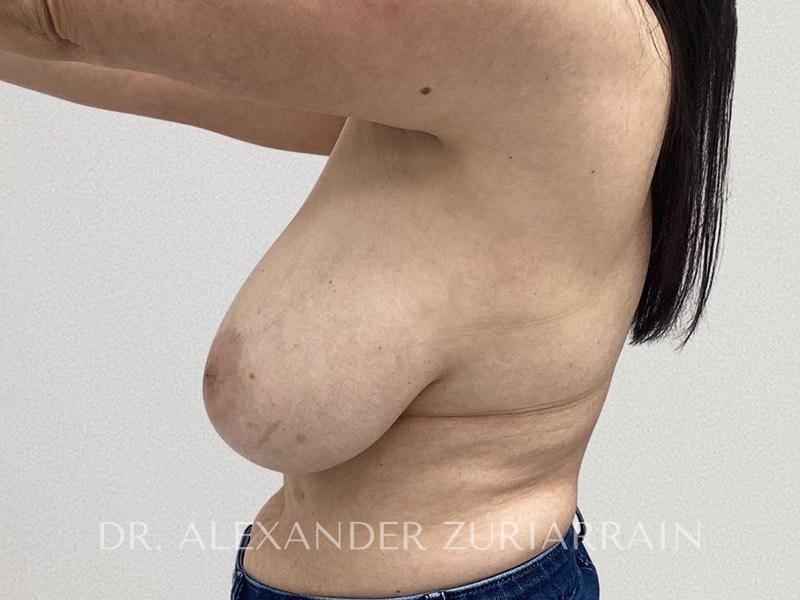 Breast reduction before & after photo