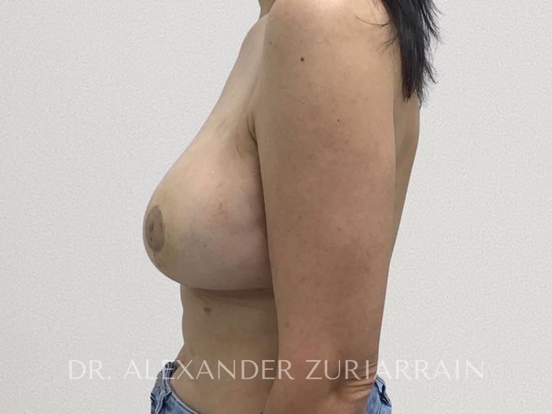Breast reduction before & after photo