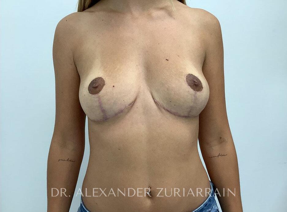 Breast revision before & after photo