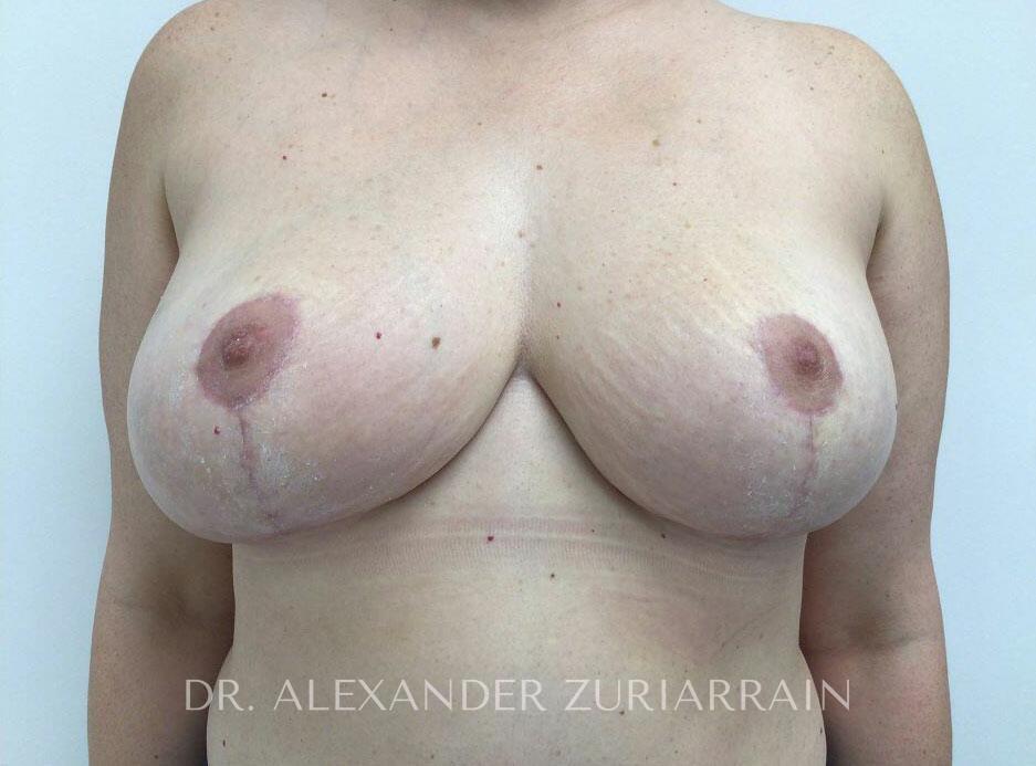 Breast revision before & after photo