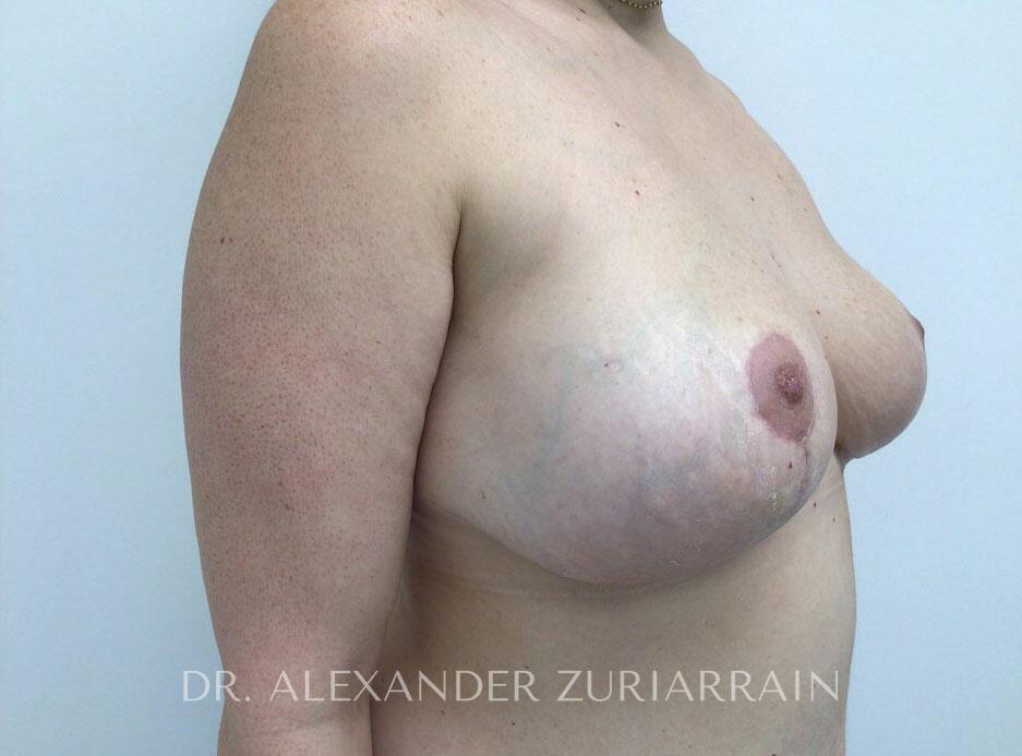 Breast revision before & after photo